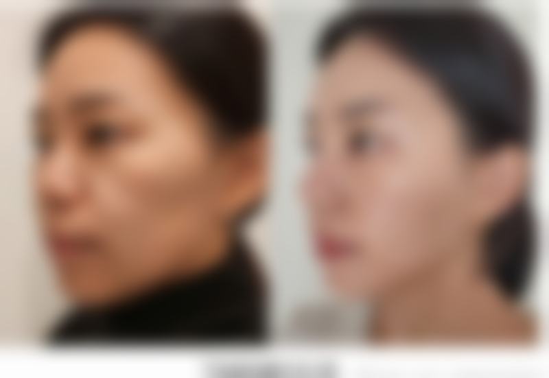 抽脂手术后塑身裤要穿多久的影响因素