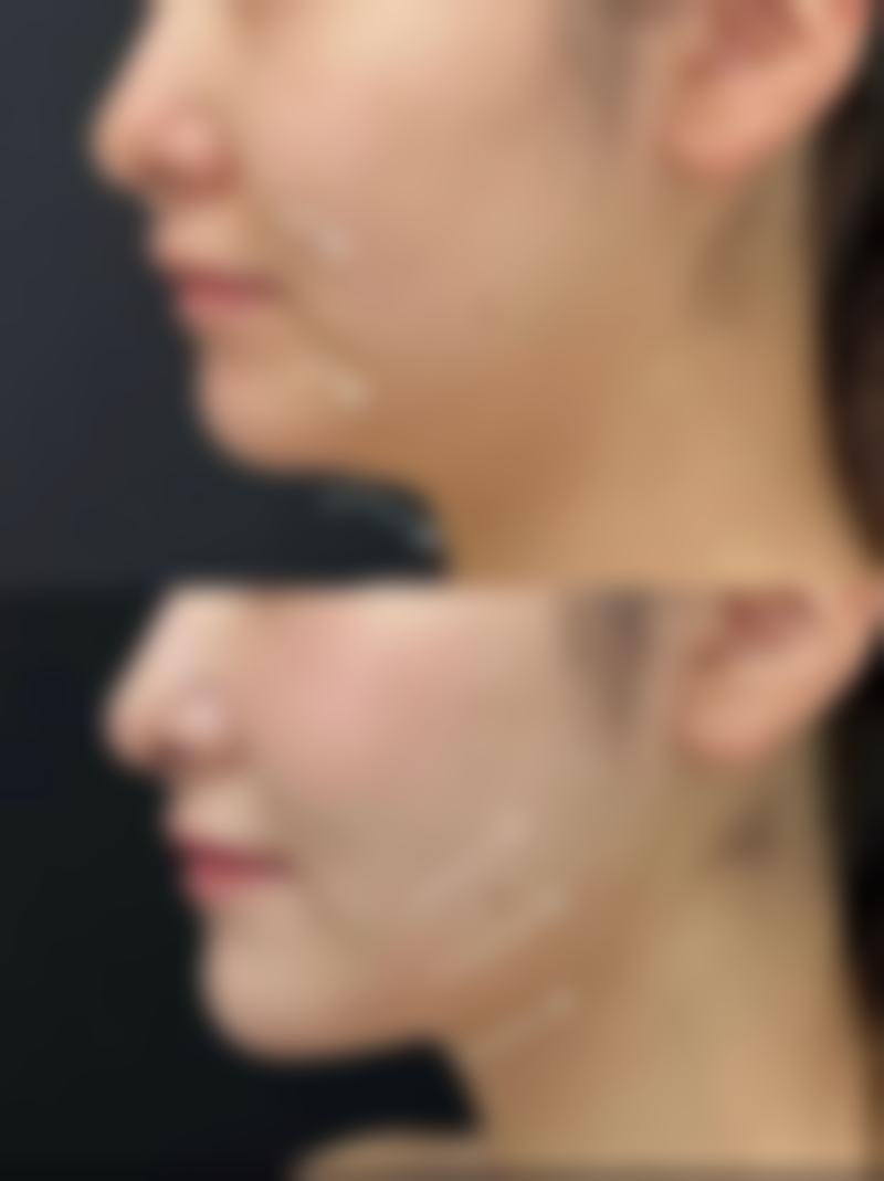 日常护理辅助改善眼袋