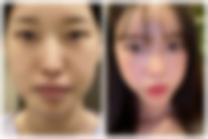 激光治疗分解增生组织