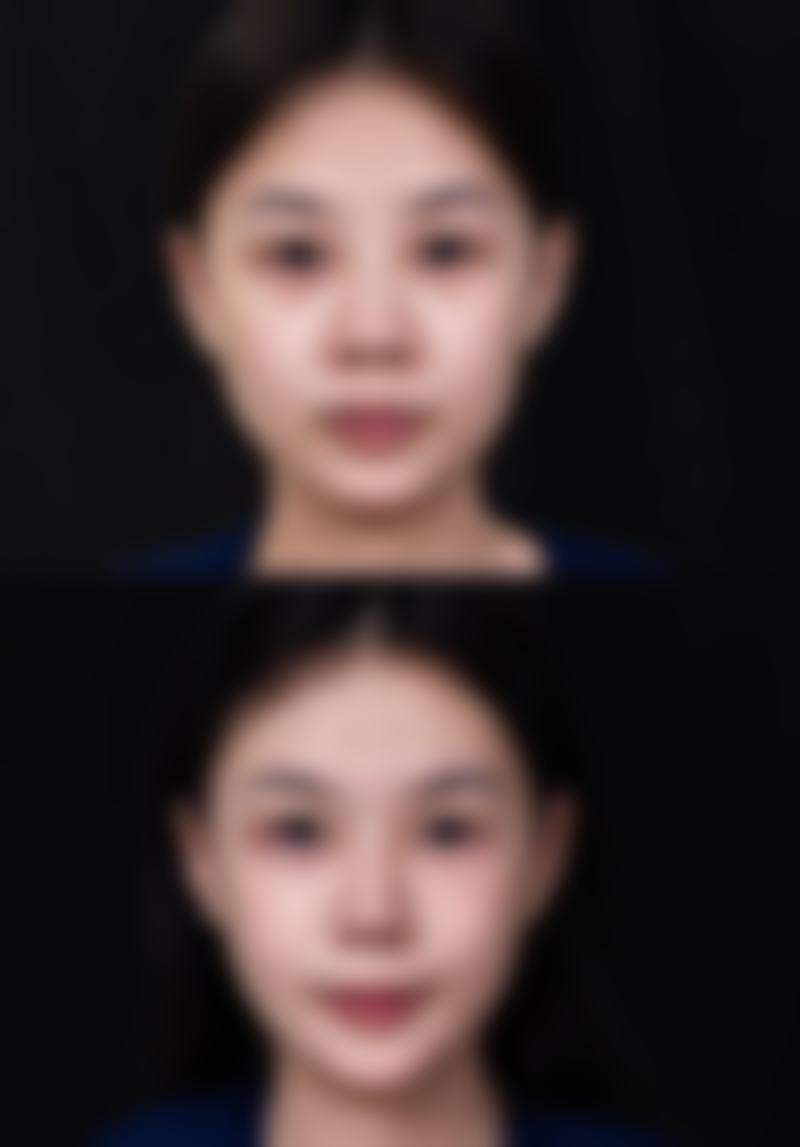 医美手段去除眼袋黑眼圈