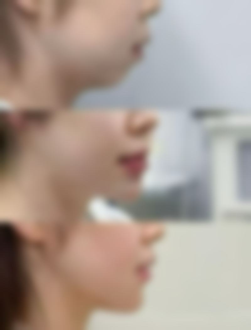 修复手术的注意事项