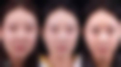 微针治疗改善去痣留下的疤痕