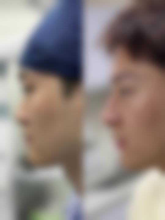 割双眼皮的手术方式对好看程度有什么影响