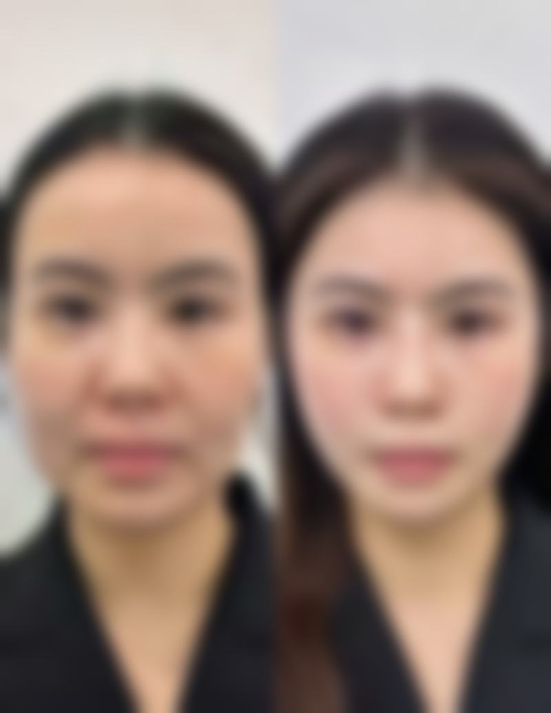 脸部瘦脸针常见的单位用量范围