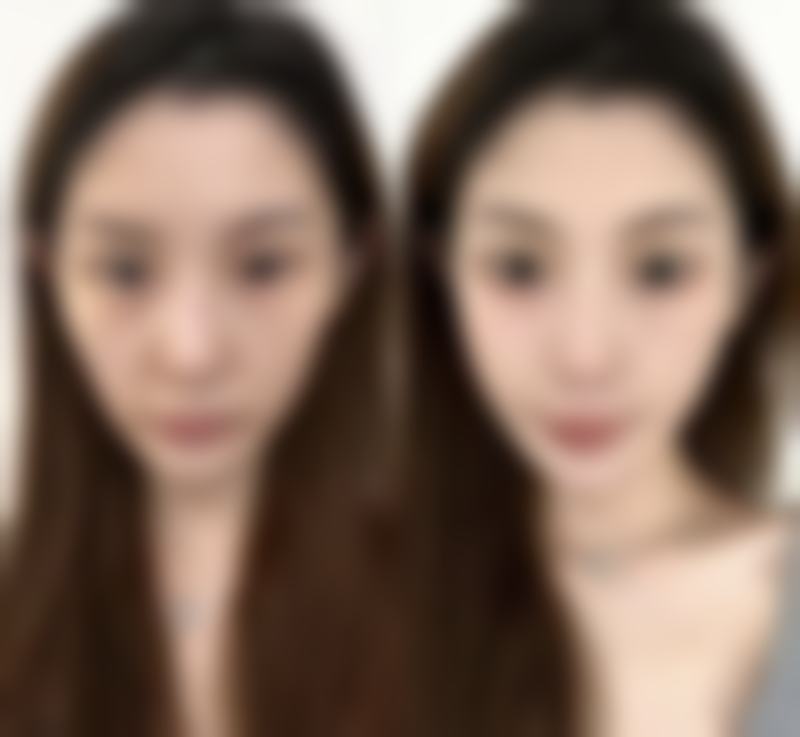 出现并发症时呼吸困难缓解时间