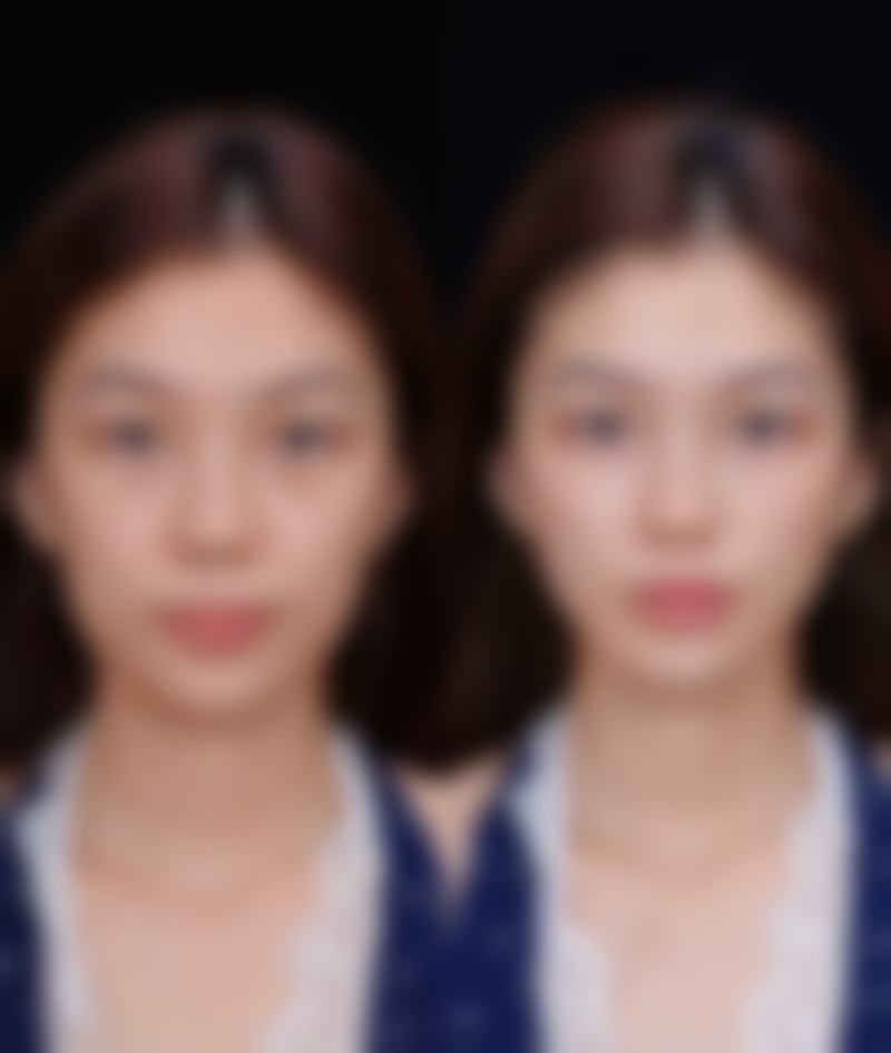 割双眼皮好看吗？好处、适用人群、风险及恢复情况都影响最终效果