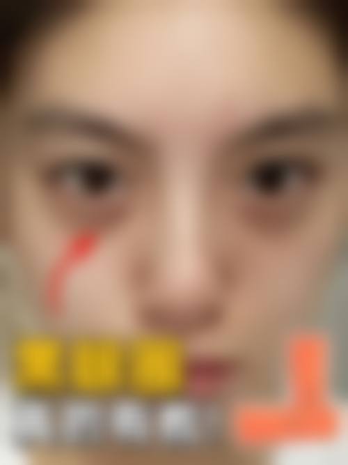 成都武侯华生铂悦美容医院眼周抗衰买1得3套餐3750元起，王玉梅医生定制方案焕亮眼周