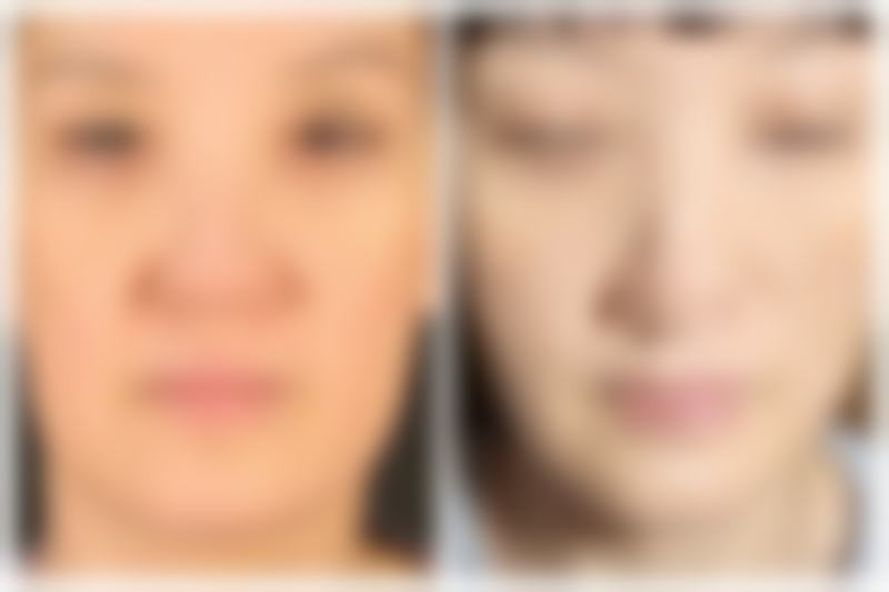 假体耳软骨隆鼻修复的阶段