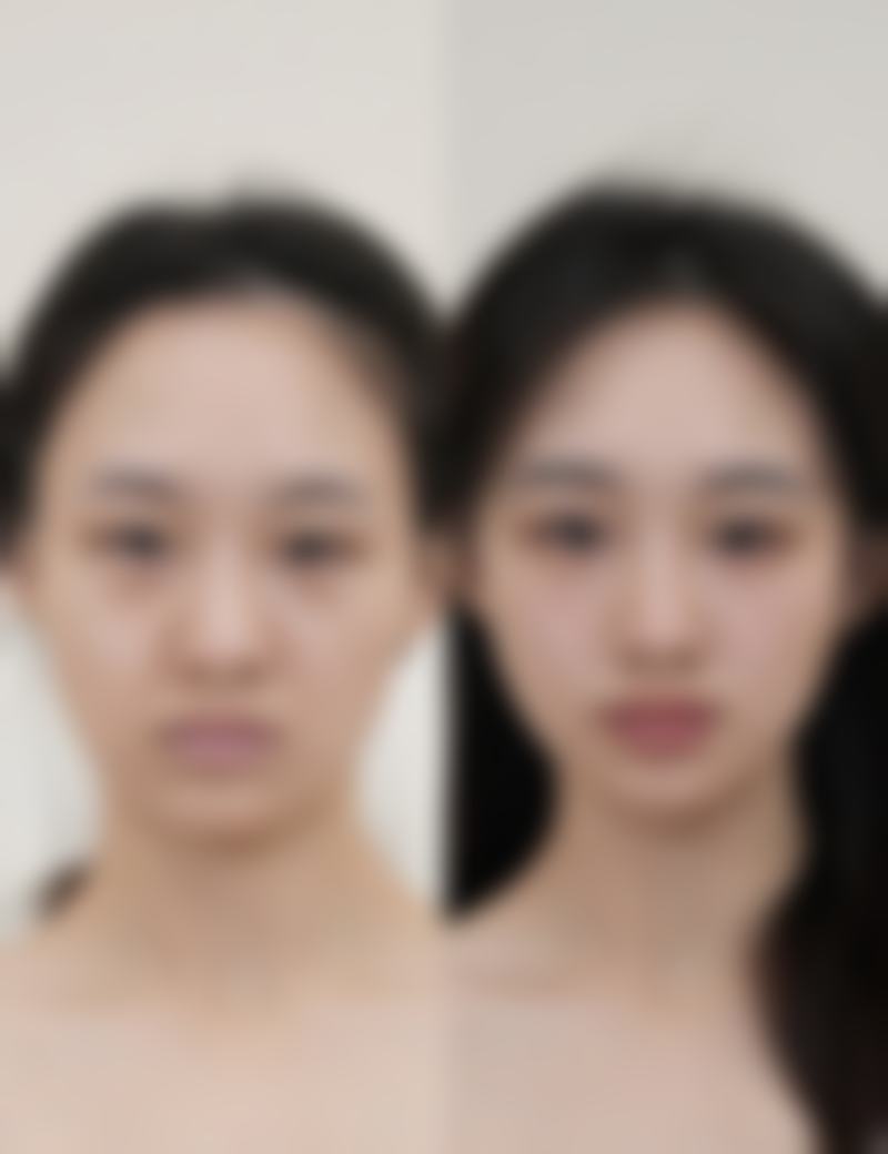 其他去除黑眼圈和眼袋的方法