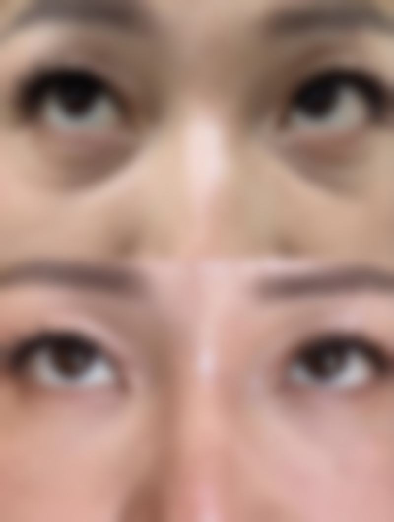 遗传因素对小婴儿双眼皮出现时间的影响
