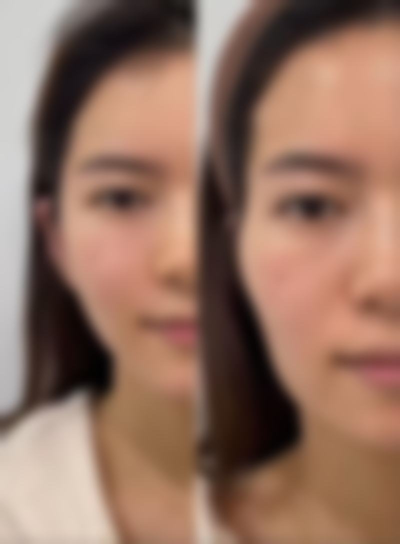 假体耳软骨隆鼻修复时间的个体差异
