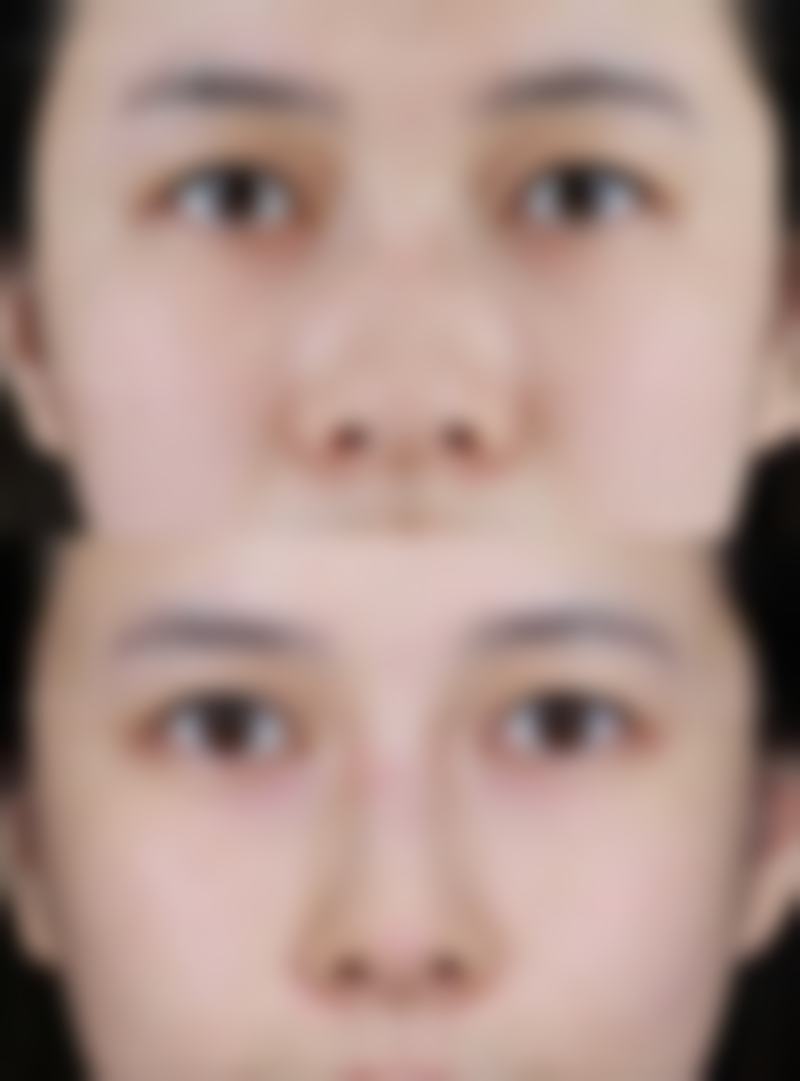 6D双眼皮与普通双眼皮的区别