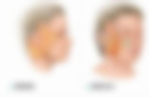 如何改善双眼皮两个宽度不一样的问题