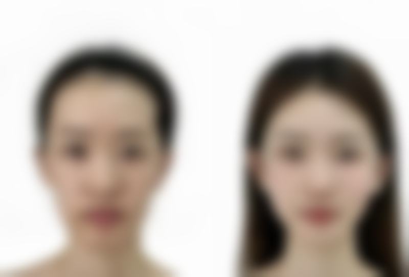 韩国艺丽人植发医院口碑如何？