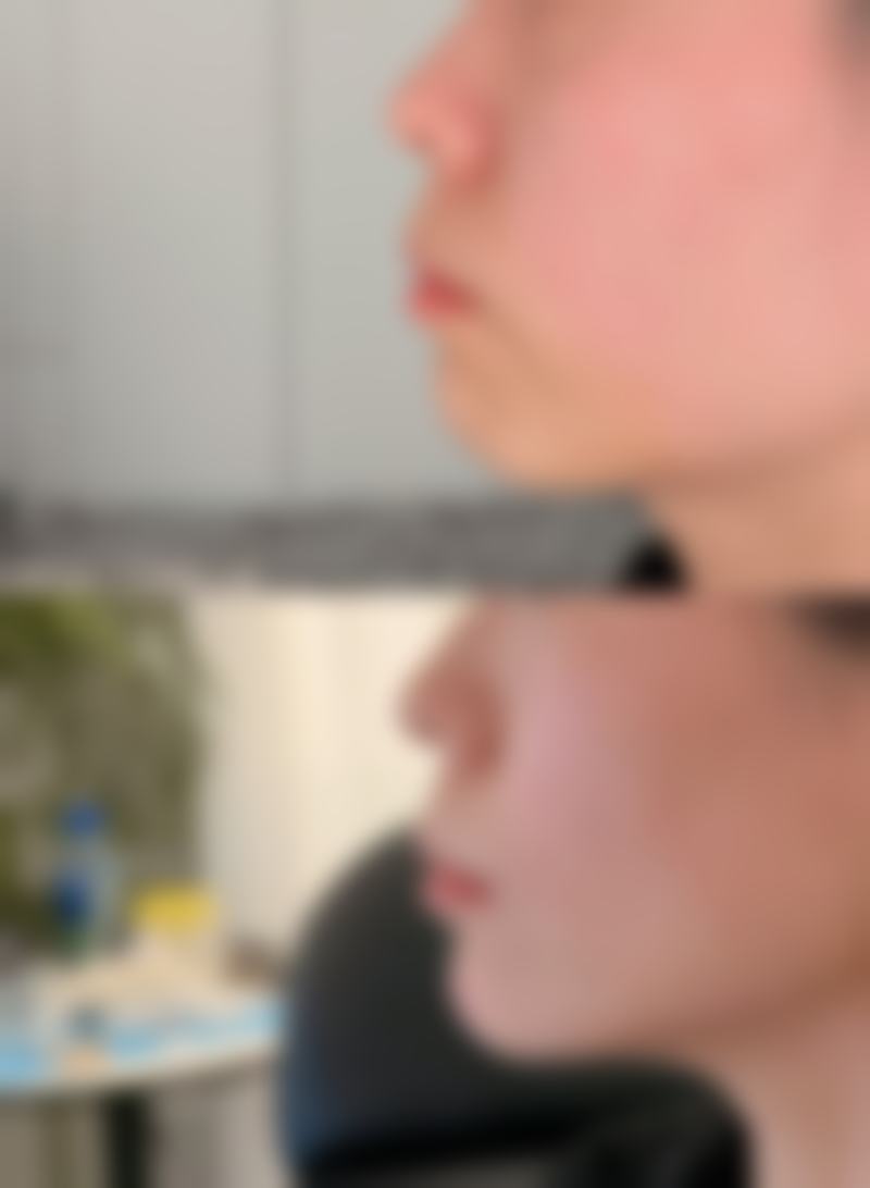 男生假体隆胸可以做多大