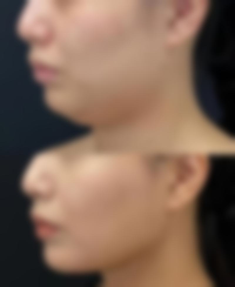 术后护理对单眼皮成双眼皮的重要性