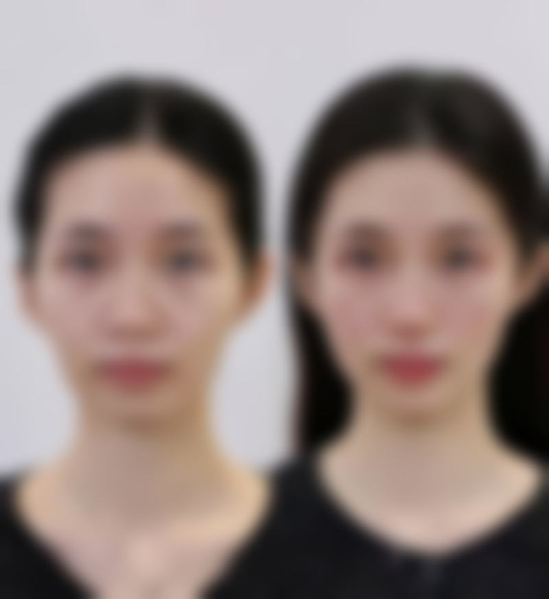 脸部疤痕怎么消除？不同类型疤痕消除方法及日常护理注意事项大揭秘