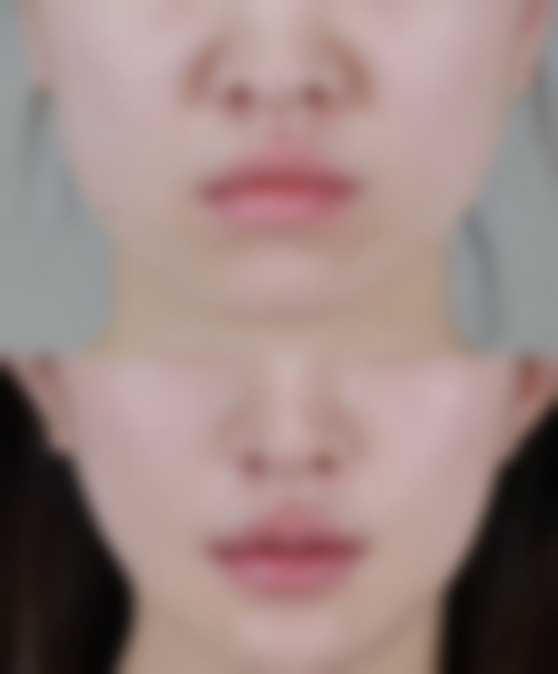 怎么能让内双眼皮变外双？非手术与手术方法全揭秘及注意事项大公开