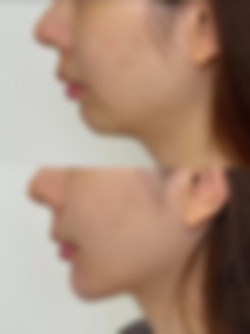 蛇毒多肽去眼袋的原理