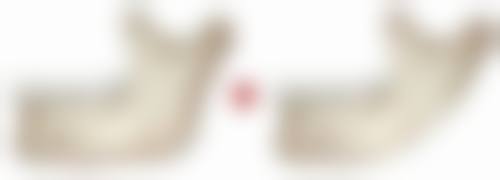 被烫伤后有白色疤痕会自己消吗？小而平或可自愈，大且明显则需治疗 