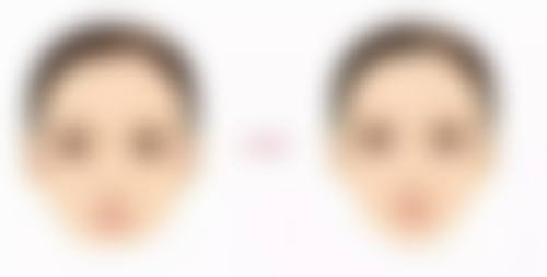 影响韩式双眼皮保持时间的因素