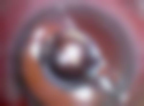 去除手术后疤痕的注意事项