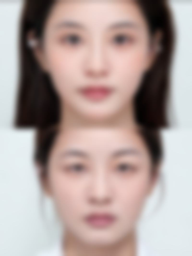 为什么做双眼皮都要你提肌？原来是与上睑下垂和效果相关，听听医生咋说