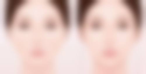 大姨妈期间不适合割双眼皮的实例