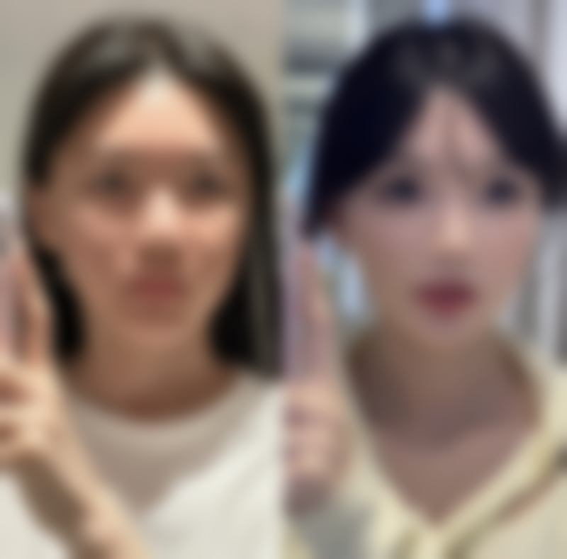 超声波去眼袋有哪些优点