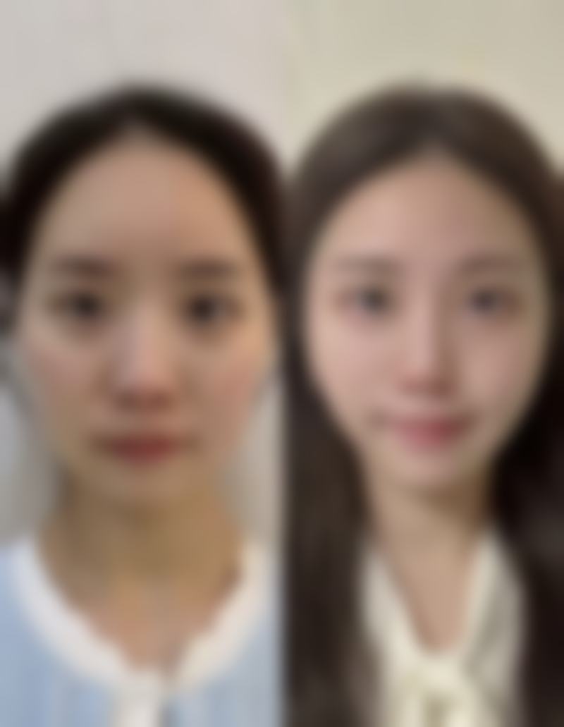 物理治疗孩子脸上的疤痕