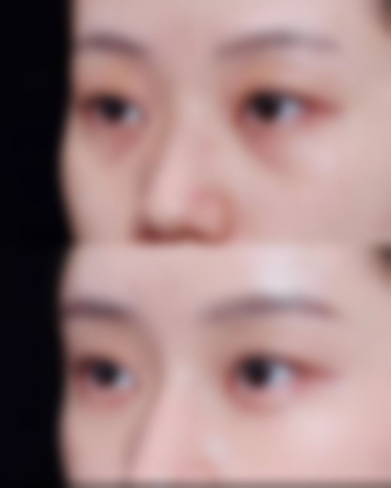 自体脂肪隆胸后揉胸的正确时机