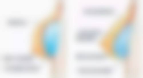 个人体质对做完双眼皮6天拆线的影响