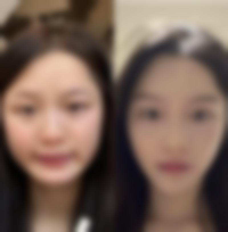 疤痕黄金修复期是多久？伤口愈合后1 - 6个月，这些修复方法你知道吗