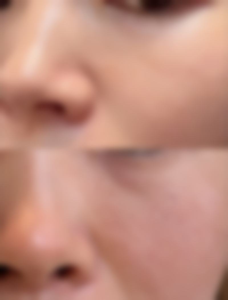 日常护理辅助去除疤痕黑印