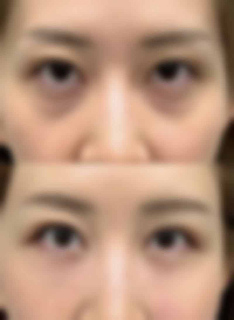 哪些情况可以不用疤痕膏