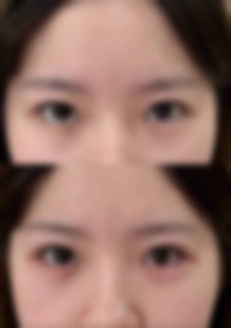 判断能否6天拆线的方法