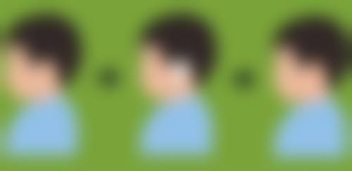 肋骨隆鼻手术后肋骨会钙化吗