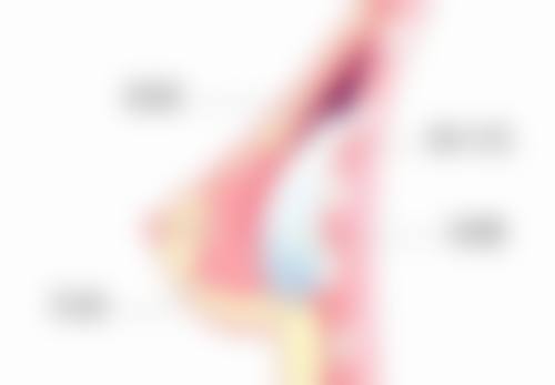 如何促进割双眼皮的手术疤痕消失