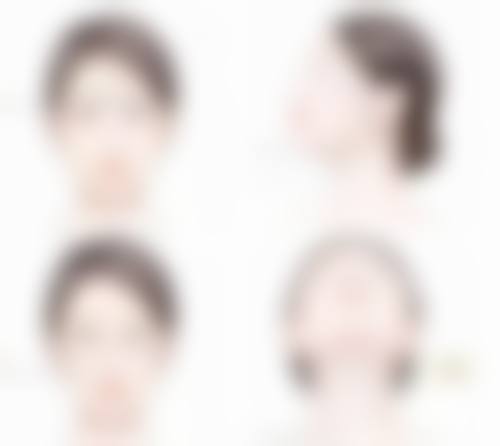 三点定位与埋线双眼皮在修复时间上的区别