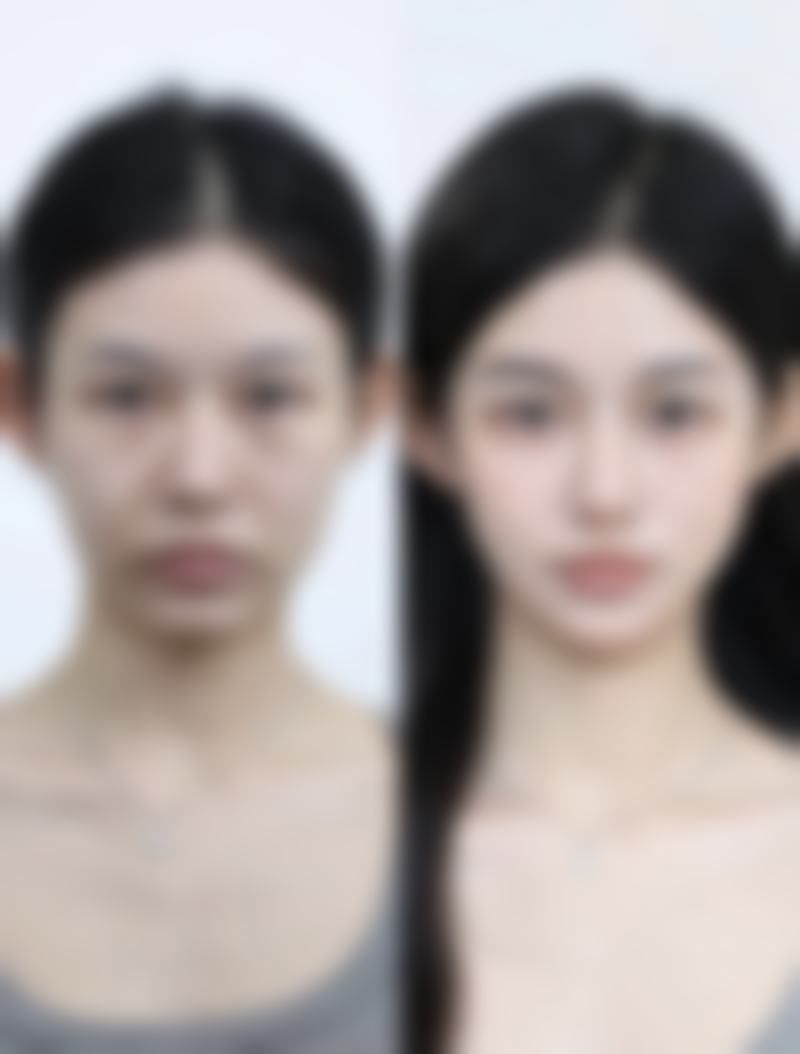 眼袋热敷多久能去掉？受多种因素影响，轻微眼袋或几周改善严重则需辅助手段
