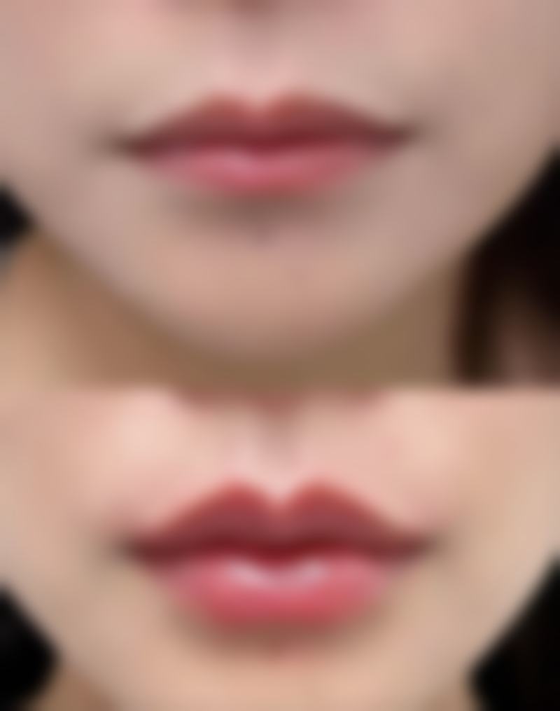 很多年的凹陷疤痕能去除吗？常见修复方法揭秘助你改善多年凹陷疤痕