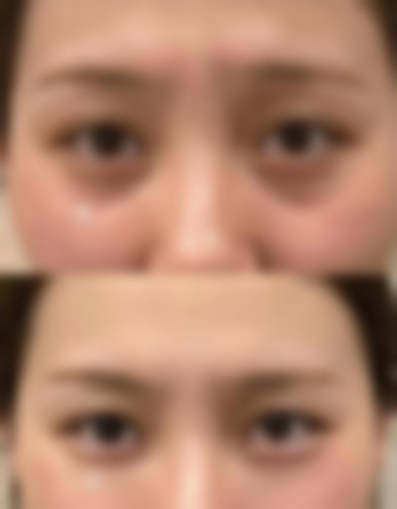 注射物取出困难的危害