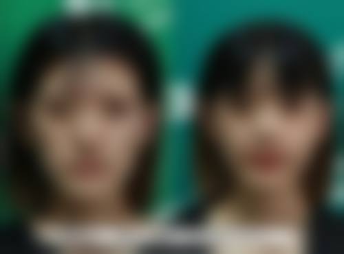 割了双眼皮疤痕多久可以恢复？受体质、护理等因素影响，一般3 - 12个月淡化