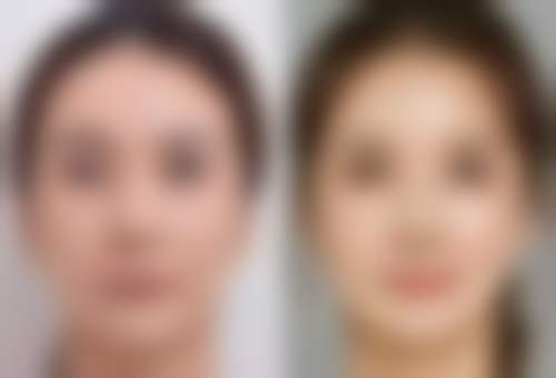 玻尿酸眼霜对眼袋的作用