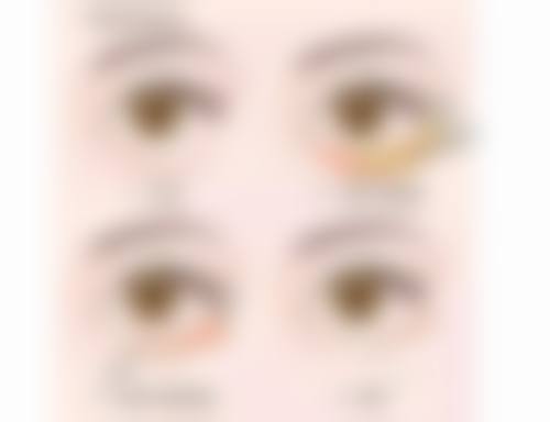 不同手术方式对疤痕修复时间的影响