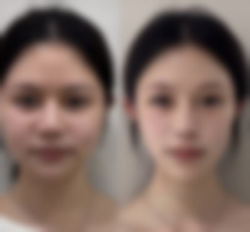 手术打造双眼皮的过程