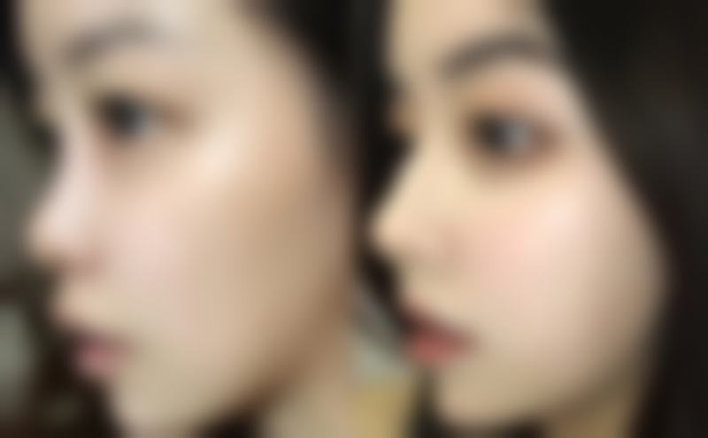 假体硅胶隆鼻后的注意事项