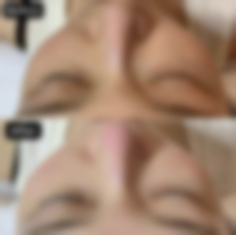 常见祛疤方式介绍