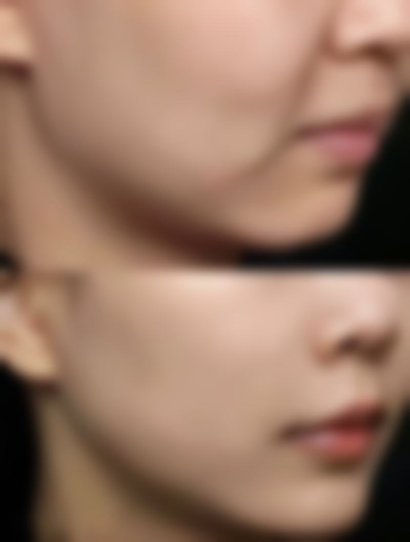 整双眼皮留疤的一般情况