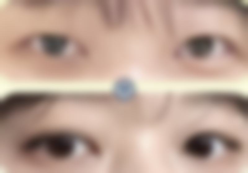 不同修复阶段灯光对眼睛的影响